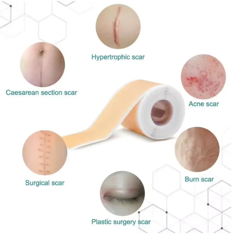 Silicone Scar Sheets